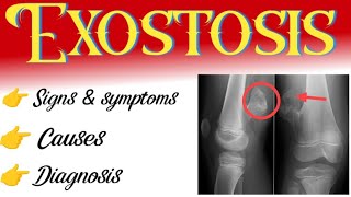 exostosis  causes  symptoms  diagnosis  treatment [upl. by Imoyik]