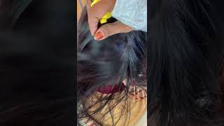 Thousand lice giant girl Head 😲 lice treatment nitsremoval headliceremoval liceremoval [upl. by Christiana]