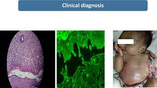 Epidermolysis Bullosa  Spot Diagnosis  9  Pediatrics [upl. by Crompton]