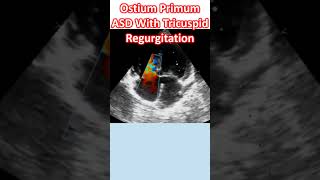 Ostium Primum ASD With Tricuspid Regurgitation [upl. by Eustache]