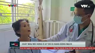 ĐIỀU TRỊ THÀNH CÔNG NGƯỜI BỆNH CHẢY MÁU MŨI HỌNG Ồ ẠT DO RÒ DỊ DẠNG ĐỘNG MẠCH [upl. by Marvin]