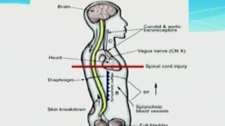 Autonomic Dysreflexia [upl. by Audwin]