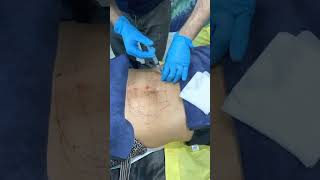 Fat Dissolving Injection to Belly at Beverly Hills Wellness Center amp Med Spa Florida shorts [upl. by Asserak267]