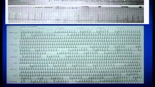 Sick sinus syndrome  Dr Narayana Namboodiri 29092013 05 [upl. by Holms]