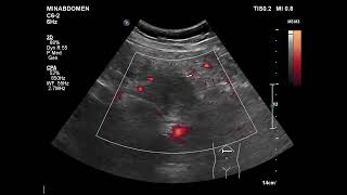 unmatching sono amp CT on pancreas [upl. by Berlyn]