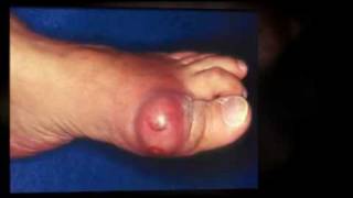 Cure Gout Dont Endure Gout Symptoms [upl. by Lim]