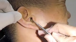 One Hard Earwax Removed form Mans Ear [upl. by Candy857]