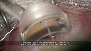 Combined cataract surgery with iStent Inject W quotWidequot glaucoma device implantation [upl. by Neerac805]