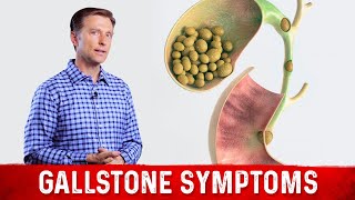 Gallstone Symptoms and Causes Explained – DrBerg on Gallbladder Stone Removal [upl. by Bordy]