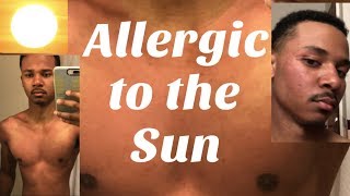 I Am Allergic to Sunlight [upl. by Gelhar]