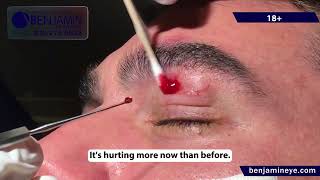 Epidermal Inclusion Cyst Removal [upl. by Uella]