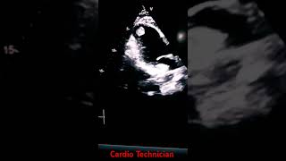 Left ventricular thrombosisApical mural thrombus [upl. by Phillips]