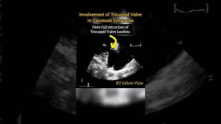 Involvement of Tricuspid Valve in Carcinoid Syndrome echocardiography [upl. by Erelia]