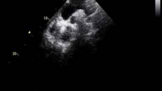 coarctation of the aorta and RHDmild mitral stenosis [upl. by Josias]