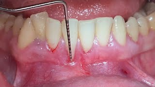 Laterally Closed Tunnel LCT for the Treatment of Deep Gingival Recession on 41  Dr Hussam Hassan [upl. by Odnumyar]