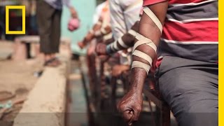 WATCH The Practice of Bloodletting in New Delhi  National Geographic [upl. by Aivilo]