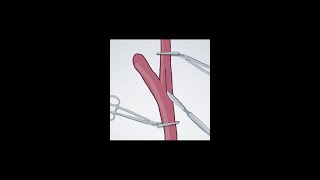 Carotid Endarterectomy shorts strokeprevention science anatomy health asmr [upl. by Quent]