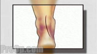 Achilles Tendon Repair Surgery PreOp® Patient Education HD [upl. by Assilrac]