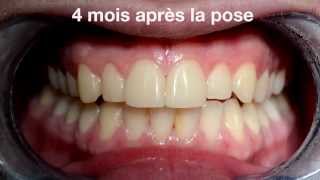 Facettes dentaires Cerec  veneers by PAG vs Ceramic crown [upl. by Dann411]