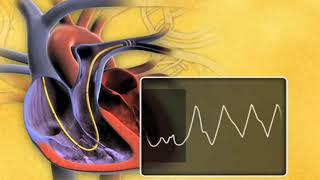 Swan Ganz Thermodilution Pulmonary Artery Catheter rdyUjTB4vaU mpeg4 [upl. by Orips4]