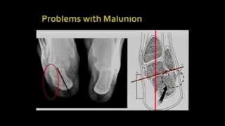 Calcaneal Malunion [upl. by Bili112]