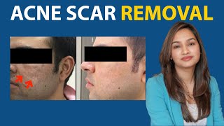 Best Treatment for Acne Dark Spots Pigmentation and Scars  Dermatologist Recommended Products [upl. by Occir]