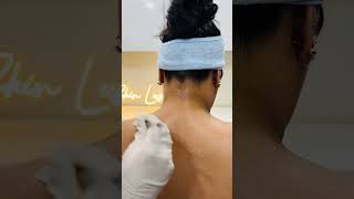 Chemical peel for body pigmentation pigmentationtrending skinpigmentation underarmpigmentation [upl. by Bohun]