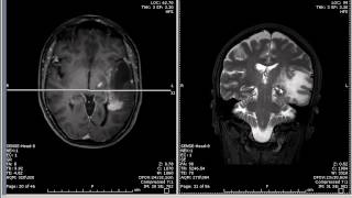 Brain Tumor mimic And Optic Tract [upl. by Arrekahs]