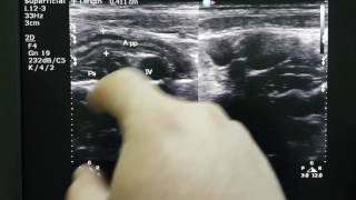 Mesenteric Lymphadenitis Sonography [upl. by Orvie]