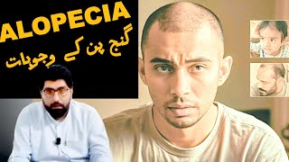 quotAlopecia causes and symptoms  بالوں کے جھڑنے کی وجوہات – گنج پن کی حقیقت اور اس سے نمٹنے کے طریقےquot [upl. by Imoyaba]