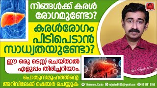 ഫാറ്റിലിവർ രോഗവും കരൾ വീക്കവും വളരെ നേരത്തെ കൃത്യമായി തിരിച്ചറിയാൻ ഒരു സിമ്പിൾ ടെസ്റ്റ് ഉണ്ട് [upl. by Nuahsyd208]