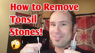 How to Easily Remove Tonsil Stones 💎💉 [upl. by Assirralc]