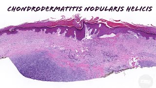 CNH chondrodermatitis nodularis helicis pathology histology dermpath dermatology [upl. by Hildegarde]