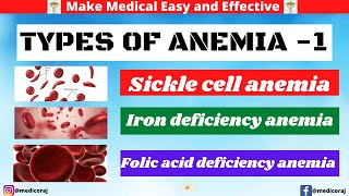 Types of anemia1sickle cell anemiaIron deficiency anemiaFolic acid deficiency anemiacauses [upl. by Saffier]