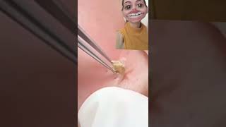 Blackheads Removal  Acne Treatment and Very Satisfying Satisfying Pimple pop blackheads [upl. by Anilra895]