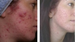 ✔ UPDATED Exposed Skin Care Review  1 Year on My Acne quotCUREquot [upl. by Jerrilyn413]