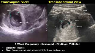 8 Week Pregnancy Obstetric Ultrasound Report Example  Normal Intrauterine Pregnancy USG  OBGYN [upl. by Aronow309]