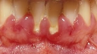 Gingivitis bacteria and inflammation but no parasites Dr Mark Bonner [upl. by Reynolds]