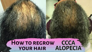 How to regrow your hair  CCCA Alopecia Central Centrifugal Cicatricial Alopecia hair care [upl. by Eadrahc]