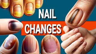 13 Nail Changes and What They Mean for Your Health [upl. by Alphonsa]