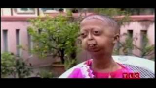 PROGERIA CHILDREN Rapid Aging Disease [upl. by Ennaylloh]