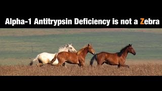 Alpha1 Antitrypsin Deficiency is Not a Zebra  BAVLS [upl. by Trista]