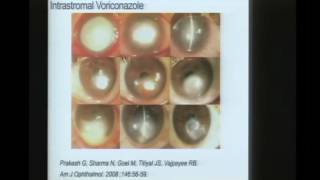 Innovations in Fungal Keratitis [upl. by Ahsirek]