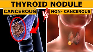 Cancerous vs Non cancerous Thyroid Nodules  How to Tell the Difference  Dr Gaurav Gangwani [upl. by Meredeth]