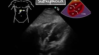 POCUS Cardiac Subxiphoid Normal EF [upl. by Un]