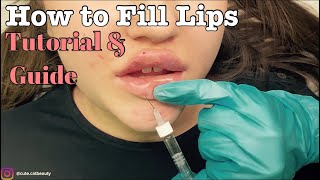 How to Fill Lips with Dermal Fillers Tutorial and Guide [upl. by Kiyohara]