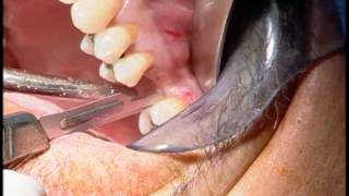 Symplait Endopore Surgical Video Osteotome Technique  pt1 [upl. by Norrek134]