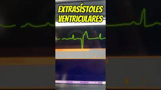 Mis extrasístoles ventriculares son de riesgo⁉️🤔⚠️ emergency cardiology [upl. by Enelyar]