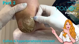 Callus amp hyperkeratosis removal 2Αφαίρεση κάλων amp υπερκερατώσεωνΚέντρο Ποδιού PodiatryPodiatrist [upl. by Naneik598]