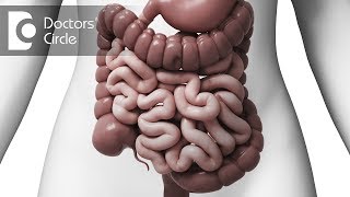 What is Intussusception in adults  Dr Nagaraj B Puttaswamy [upl. by Anaele]